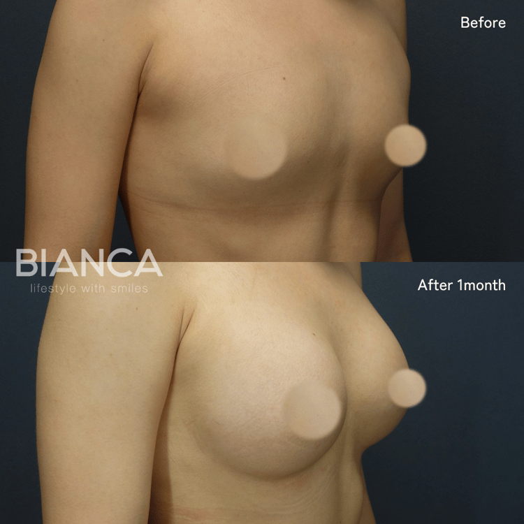 シリコンバッグ豊胸