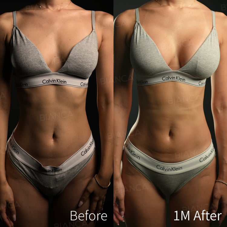 シリコンバッグ豊胸