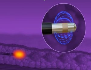 クォンタムRF|BIANCA CLINIC